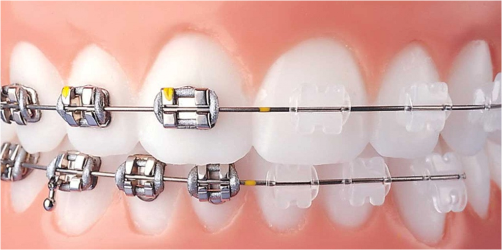 Braces and Invisible Aligners